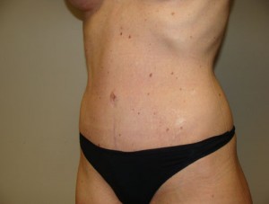 Tummy Tuck Before and After 14 | Sanjay Grover MD FACS