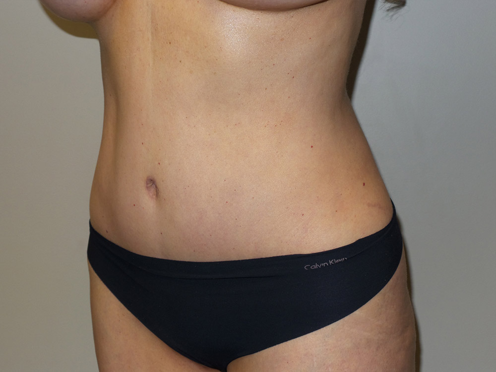 Tummy Tuck Before and After 20 | Sanjay Grover MD FACS