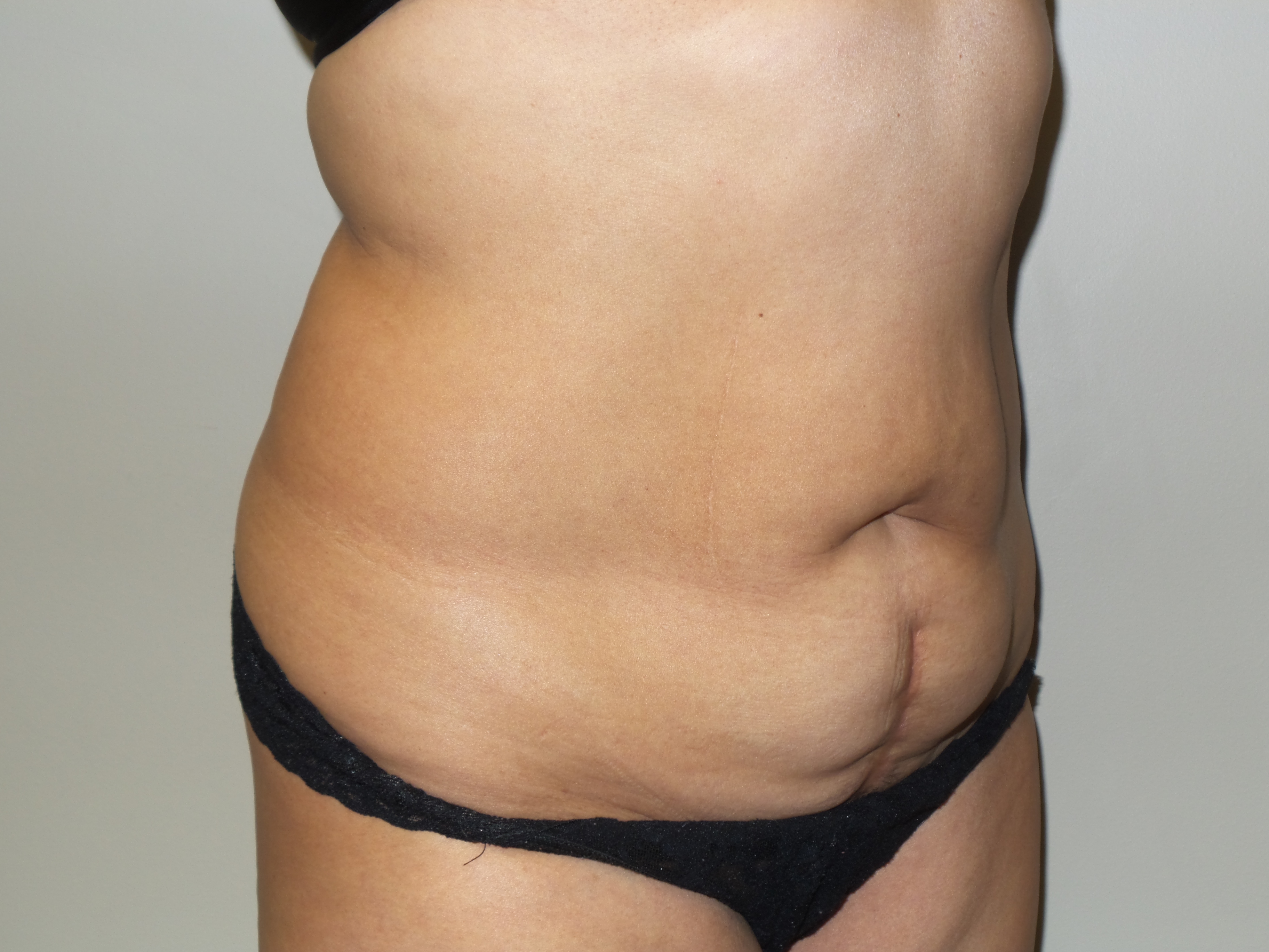 Tummy Tuck Before and After 25 | Sanjay Grover MD FACS