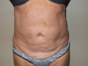 Tummy Tuck Before and After 29 | Sanjay Grover MD FACS