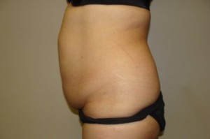 Tummy Tuck Before and After 26 | Sanjay Grover MD FACS