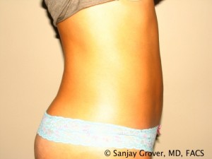 Tummy Tuck Before and After 34 | Sanjay Grover MD FACS