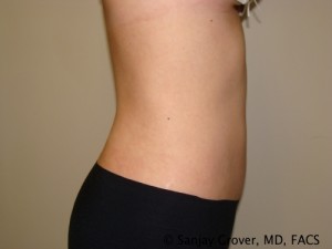 Tummy Tuck Before and After 35 | Sanjay Grover MD FACS