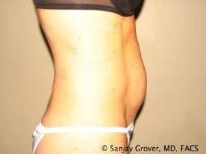 Tummy Tuck Before and After 36 | Sanjay Grover MD FACS