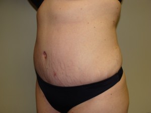 Tummy Tuck Before and After 57 | Sanjay Grover MD FACS