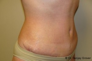 Tummy Tuck Before and After 58 | Sanjay Grover MD FACS