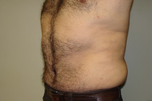 Tummy Tuck Before and After 62 | Sanjay Grover MD FACS