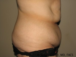 Tummy Tuck Before and After 76 | Sanjay Grover MD FACS