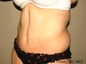 Tummy Tuck Before and After 76 | Sanjay Grover MD FACS