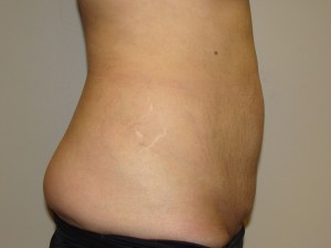 Tummy Tuck Before and After 88 | Sanjay Grover MD FACS