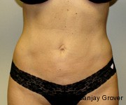 Velashape Before and After | Sanjay Grover MD FACS