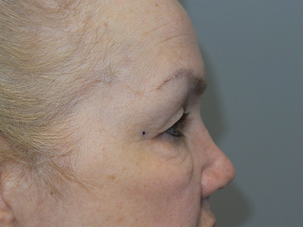 Blepharoplasty Before and After 02 | Sanjay Grover MD FACS