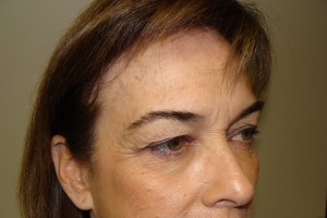 Blepharoplasty Before and After 07 | Sanjay Grover MD FACS