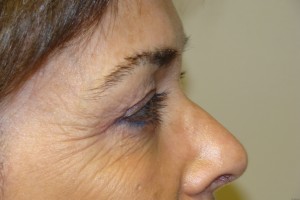 Blepharoplasty Before and After 07 | Sanjay Grover MD FACS