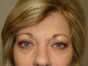 Blepharoplasty Before and After 02 | Sanjay Grover MD FACS