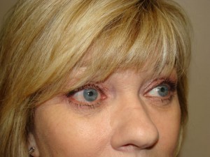 Blepharoplasty Before and After 08 | Sanjay Grover MD FACS