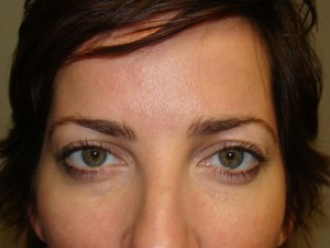 Blepharoplasty Before and After 06 | Sanjay Grover MD FACS