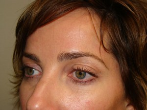 Blepharoplasty Before and After 09 | Sanjay Grover MD FACS