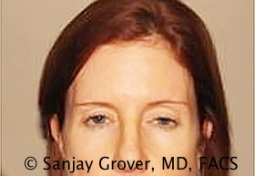 Blepharoplasty Before and After 01 | Sanjay Grover MD FACS