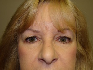 Blepharoplasty Before and After 21 | Sanjay Grover MD FACS