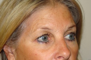 Blepharoplasty Before and After 18 | Sanjay Grover MD FACS