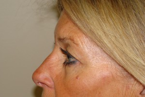 Blepharoplasty Before and After 18 | Sanjay Grover MD FACS