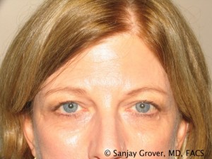 Blepharoplasty Before and After 08 | Sanjay Grover MD FACS