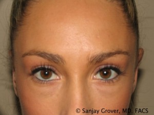 Blepharoplasty Before and After 20 | Sanjay Grover MD FACS