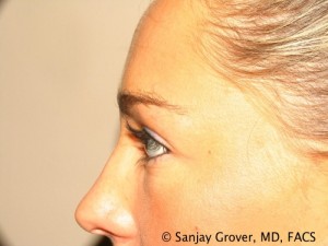 Blepharoplasty Before and After 22 | Sanjay Grover MD FACS