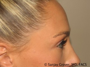 Blepharoplasty Before and After 22 | Sanjay Grover MD FACS