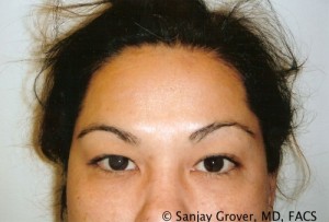 Blepharoplasty Before and After 25 | Sanjay Grover MD FACS