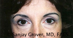 Blepharoplasty Before and After 01 | Sanjay Grover MD FACS