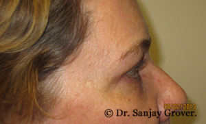 Blepharoplasty Before and After 35 | Sanjay Grover MD FACS