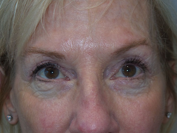 Blepharoplasty Before and After 34 | Sanjay Grover MD FACS