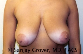 Breast Lift Before and After 20 | Sanjay Grover MD FACS