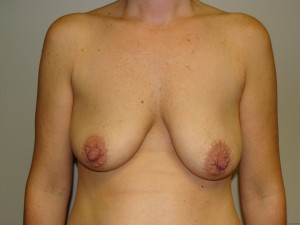 Breast Lift Before and After 41 | Sanjay Grover MD FACS