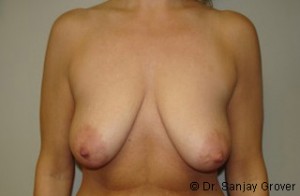 Breast Lift Before and After 27 | Sanjay Grover MD FACS