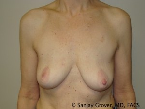Breast Lift Before and After 13 | Sanjay Grover MD FACS