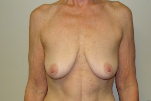 Breast Lift Before and After 40 | Sanjay Grover MD FACS