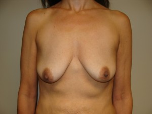 Breast Lift Before and After 39 | Sanjay Grover MD FACS