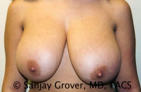 Breast Reduction Before and After 20 | Sanjay Grover MD FACS