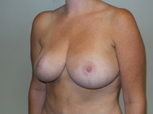 Breast Reduction Before and After 09 | Sanjay Grover MD FACS