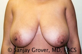Breast Reduction Before and After 17 | Sanjay Grover MD FACS