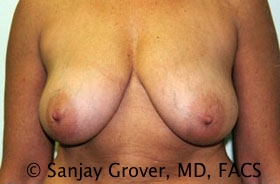 Breast Reduction Before and After 05 | Sanjay Grover MD FACS