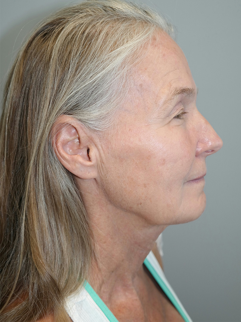 Facelift Before and After 03 | Sanjay Grover MD FACS