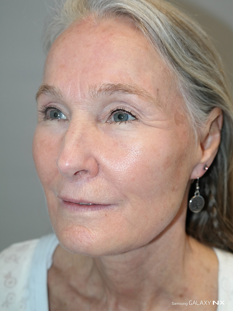 Facelift Before and After 03 | Sanjay Grover MD FACS