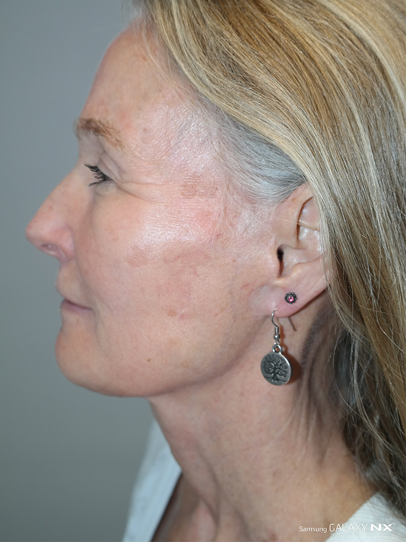 Facelift Before and After 03 | Sanjay Grover MD FACS