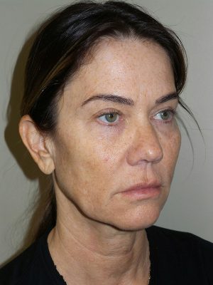 Facelift Before and After 32 | Sanjay Grover MD FACS