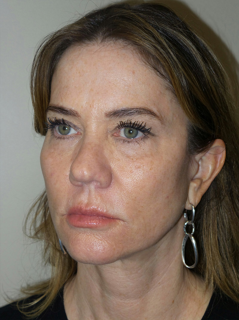 Facelift Before and After 04 | Sanjay Grover MD FACS