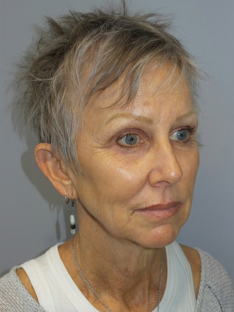 Facelift Before and After 11 | Sanjay Grover MD FACS